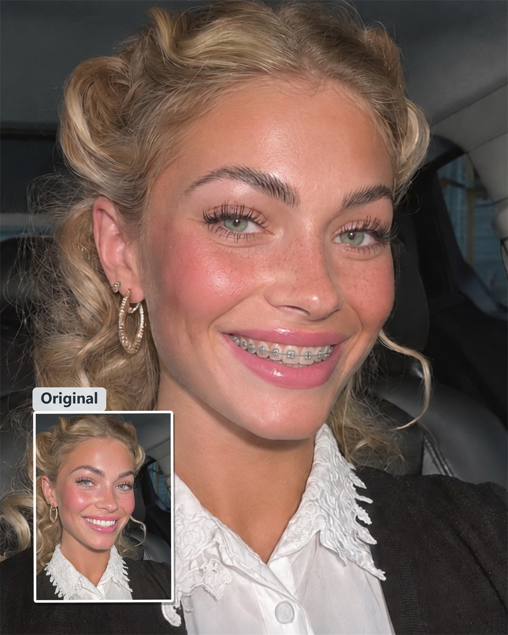 AI Braces Filter
